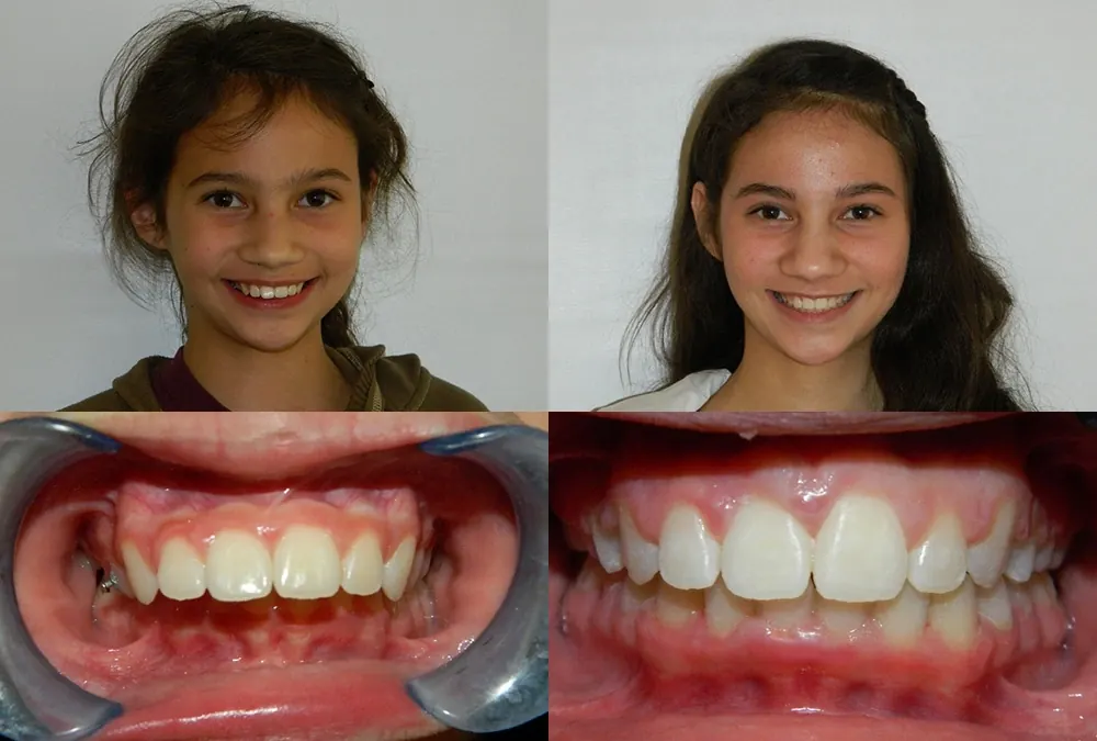 Before and after orthodontic treatment at McInnes Palmer Orthodontics, case 1: the patient's smile and teeth before treatment on the left, after on the right.