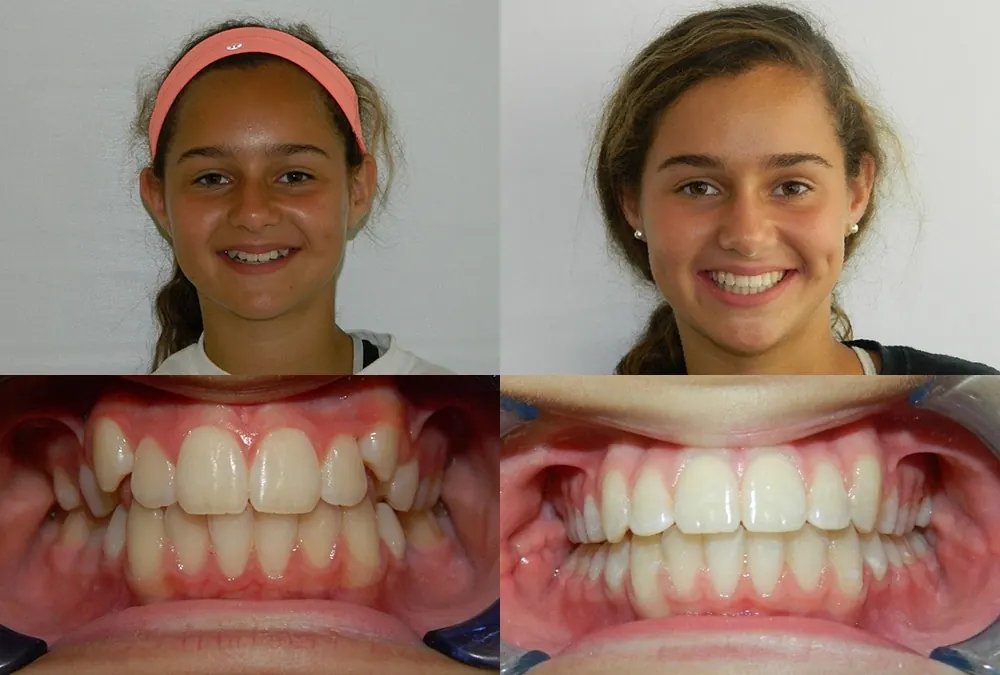 Before and after orthodontic treatment at McInnes Palmer Orthodontics, case 2: the patient's smile and teeth before treatment on the left, after on the right.