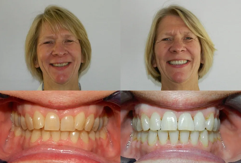 Before and after orthodontic treatment at McInnes Palmer Orthodontics, case 3: the patient's smile and teeth before treatment on the left, after on the right.