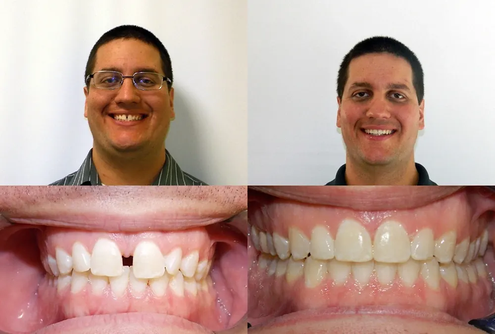 Before and after orthodontic treatment at McInnes Palmer Orthodontics, case 4: the patient's smile and teeth before treatment on the left, after on the right.