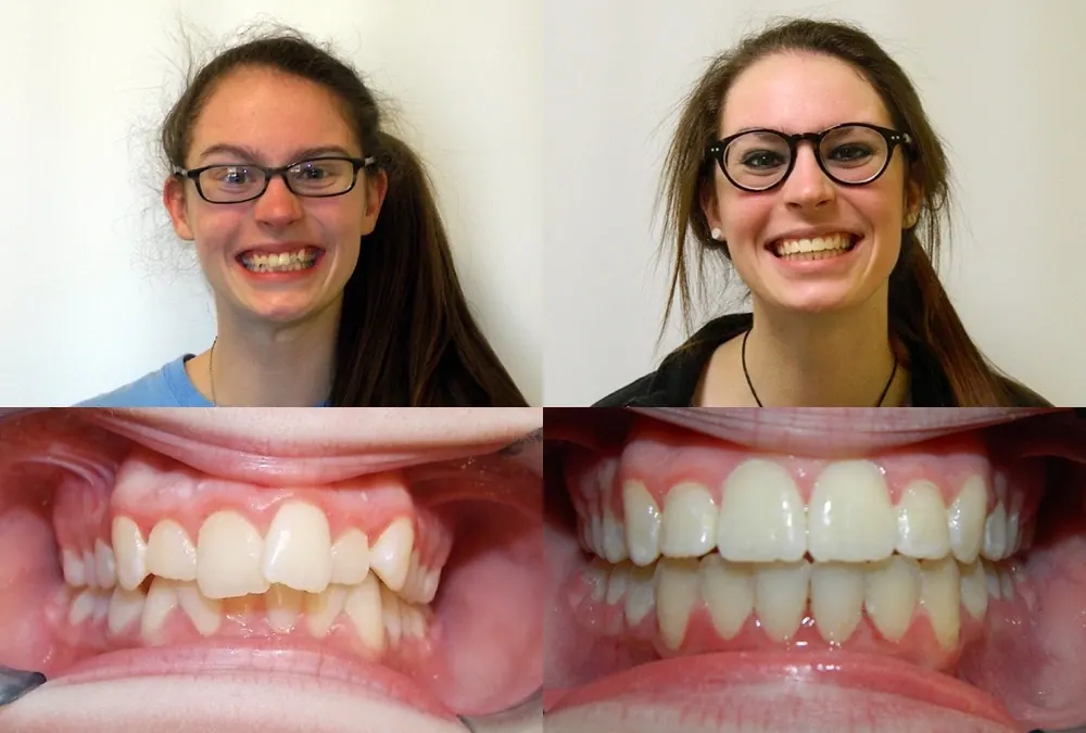 Before and after orthodontic treatment at McInnes Palmer Orthodontics, case 5: the patient's smile and teeth before treatment on the left, after on the right.