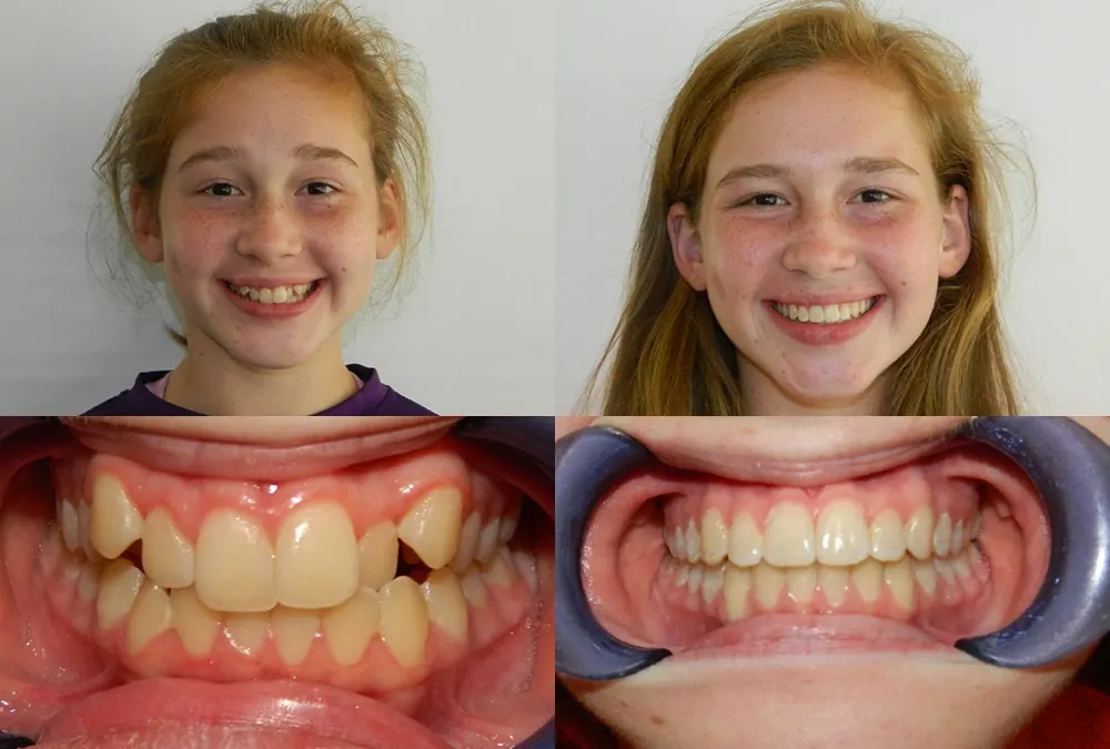 Before and after orthodontic treatment at McInnes Palmer Orthodontics, case 6: the patient's smile and teeth before treatment on the left, after on the right.